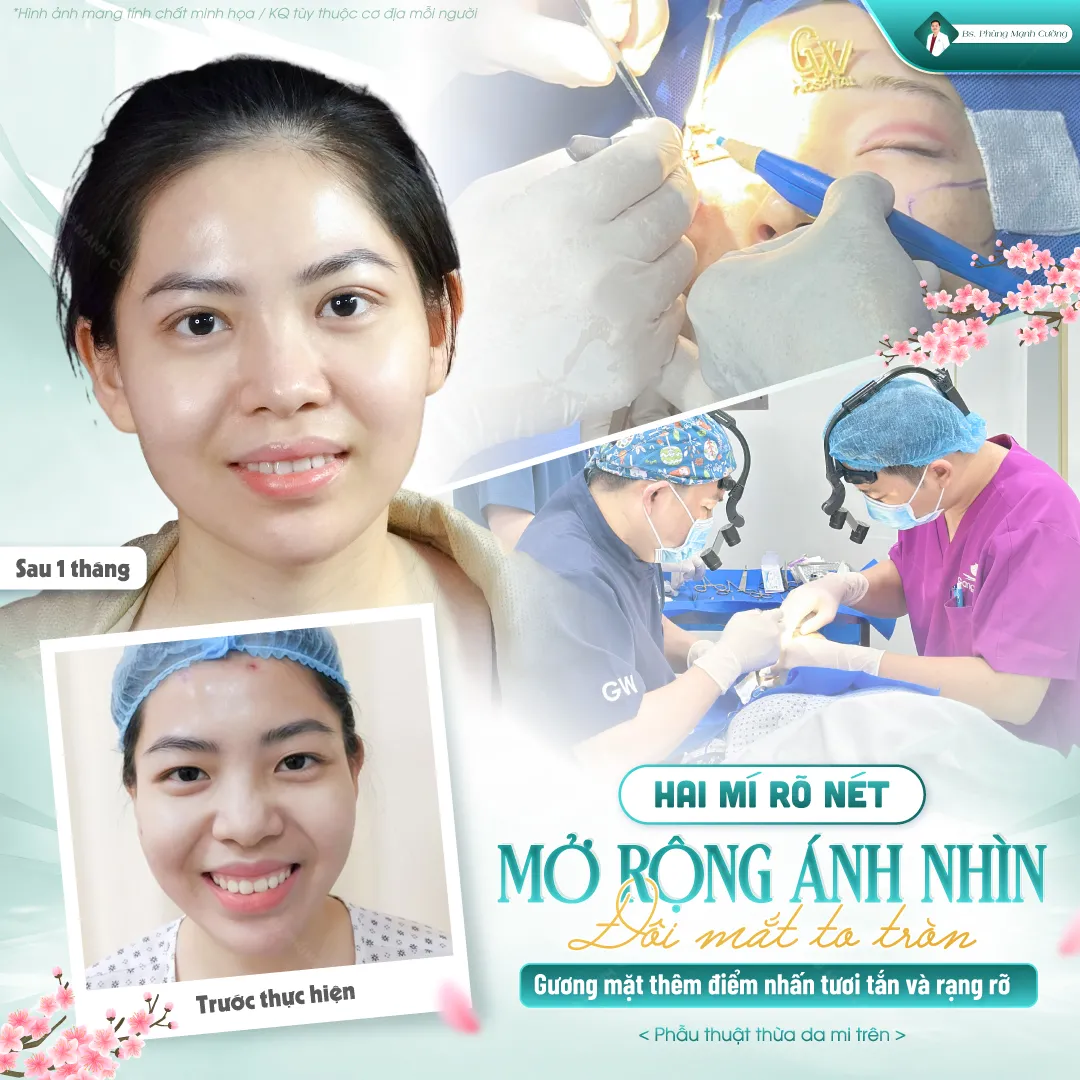 Tìm hiểu mắt mí lót là và cách khắc phục hiệu quả