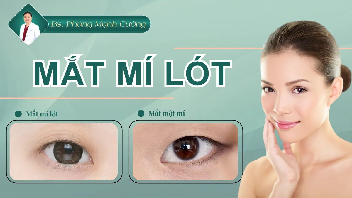 Mắt mí lót là như thế nào