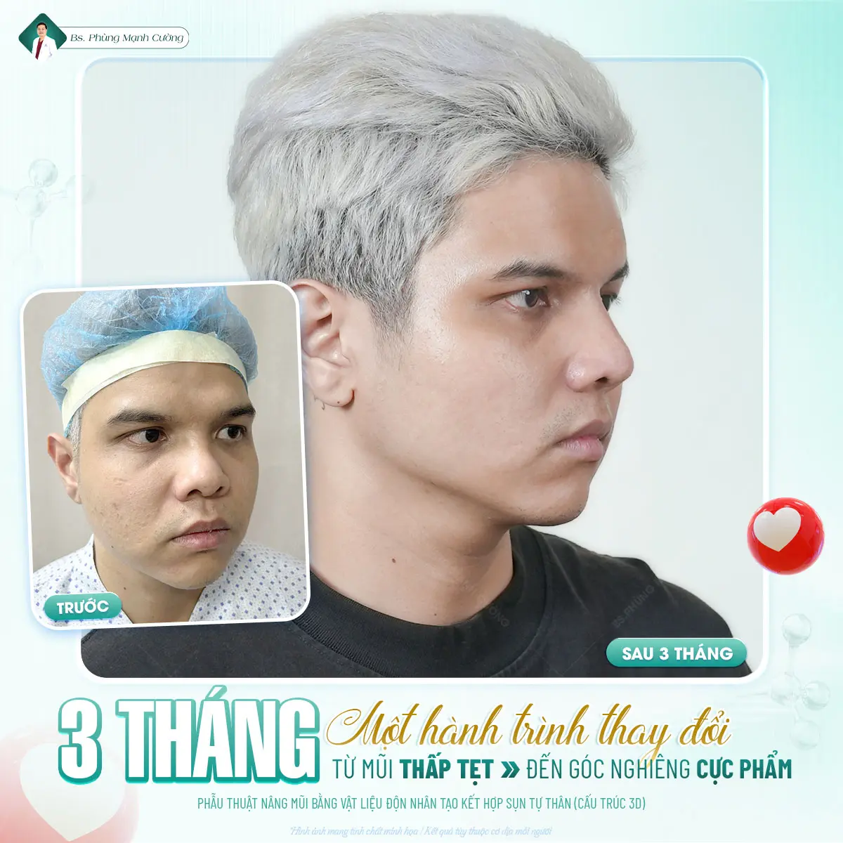 Nâng mũi sụn tai: Lợi ích và những điều bạn cần biết 12 Tìm hiểu về đặc điểm của nâng mũi sụn tai