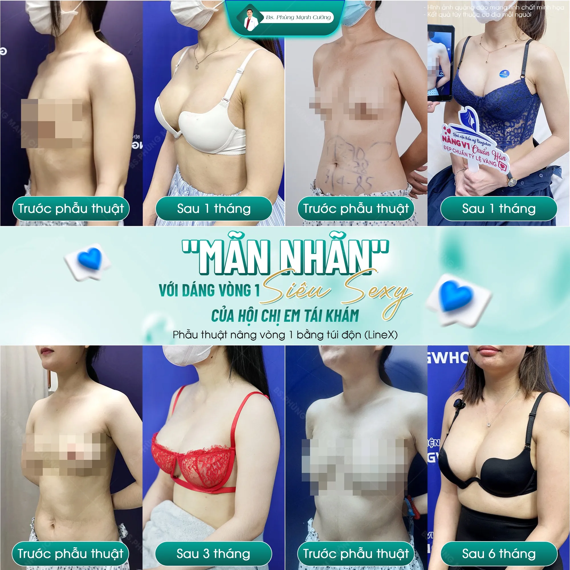 Nâng Ngực Túi Arion Vi Nhám Chuẩn Hàn