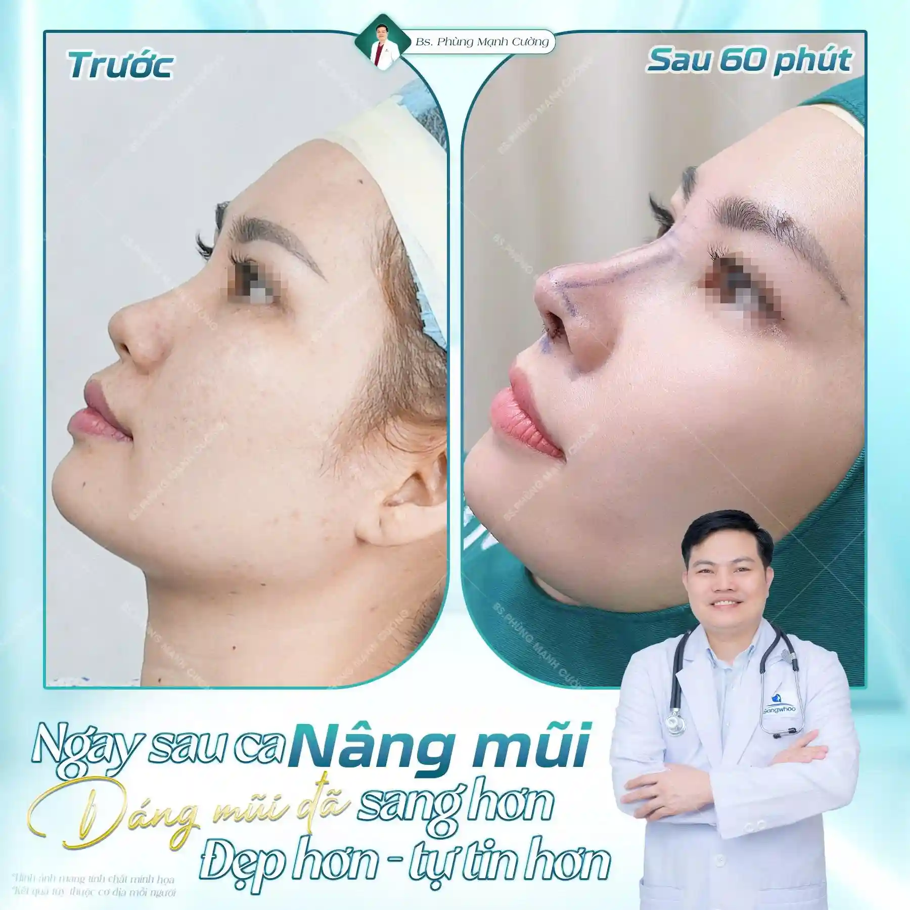 Thông thường sau 1 đến 3 tháng mũi sẽ vào form ổn định và đẹp