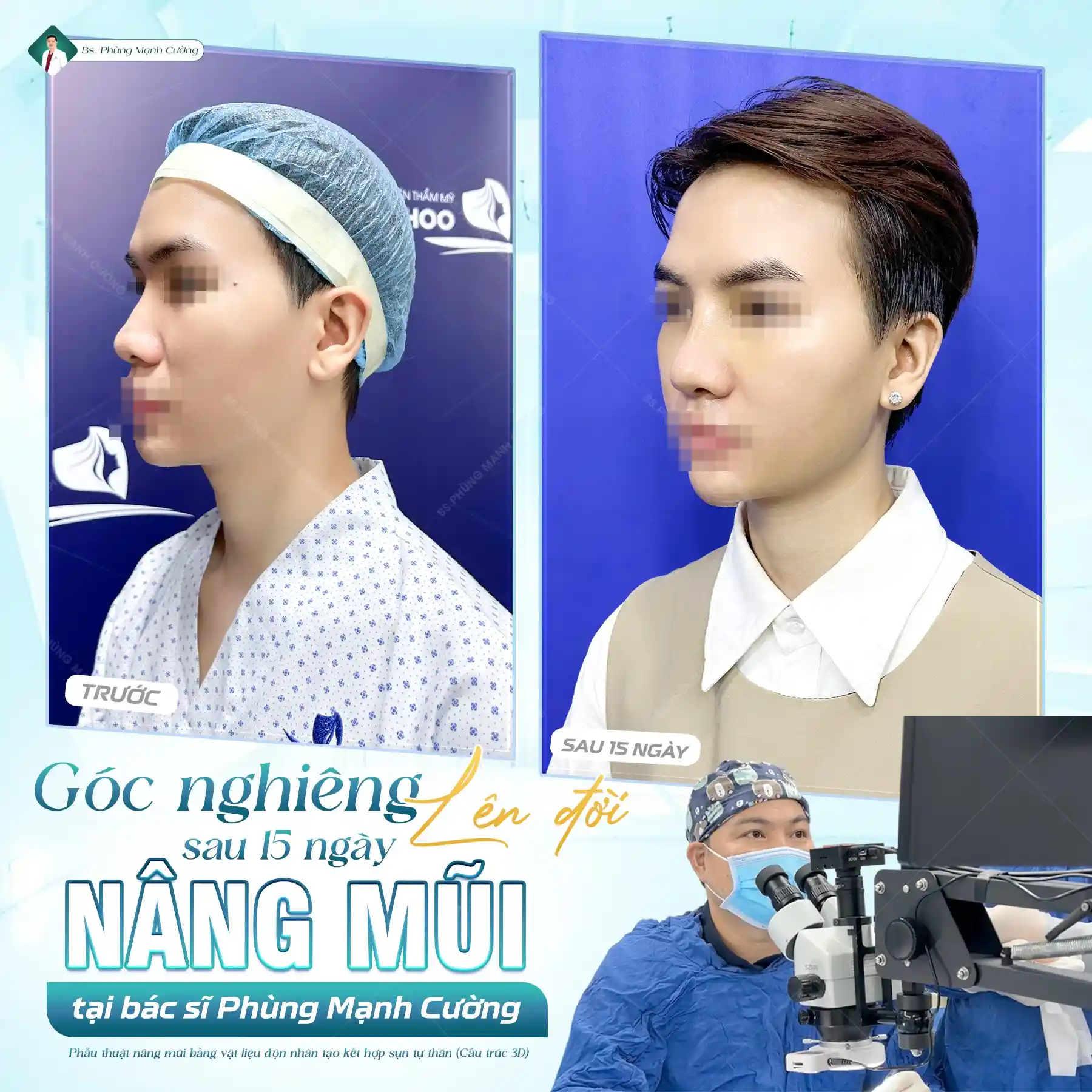 Tìm hiểu các giai đoạn hồi phục sau nâng mũi