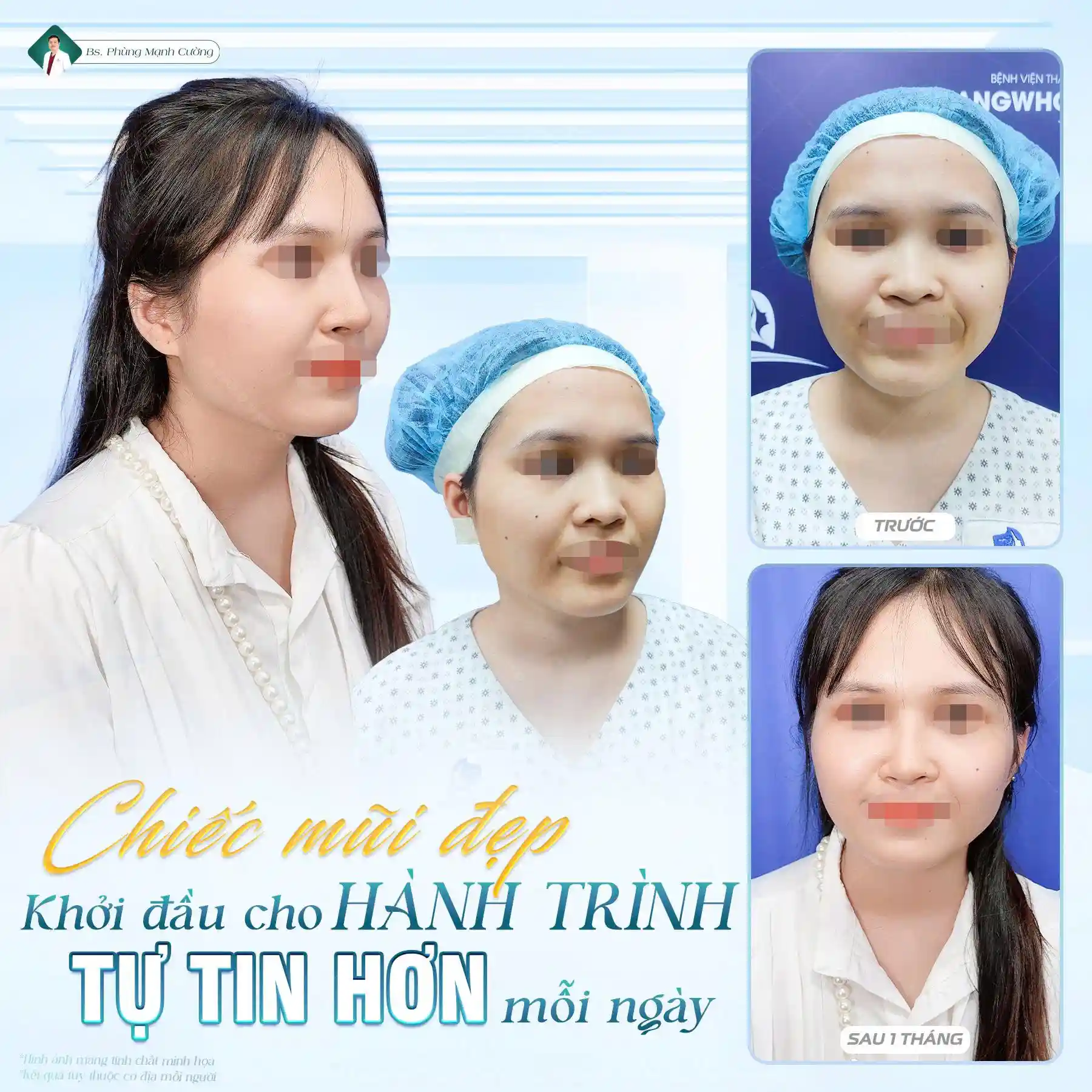 Tham khảo các cơ sở nâng mũi S line đẹp