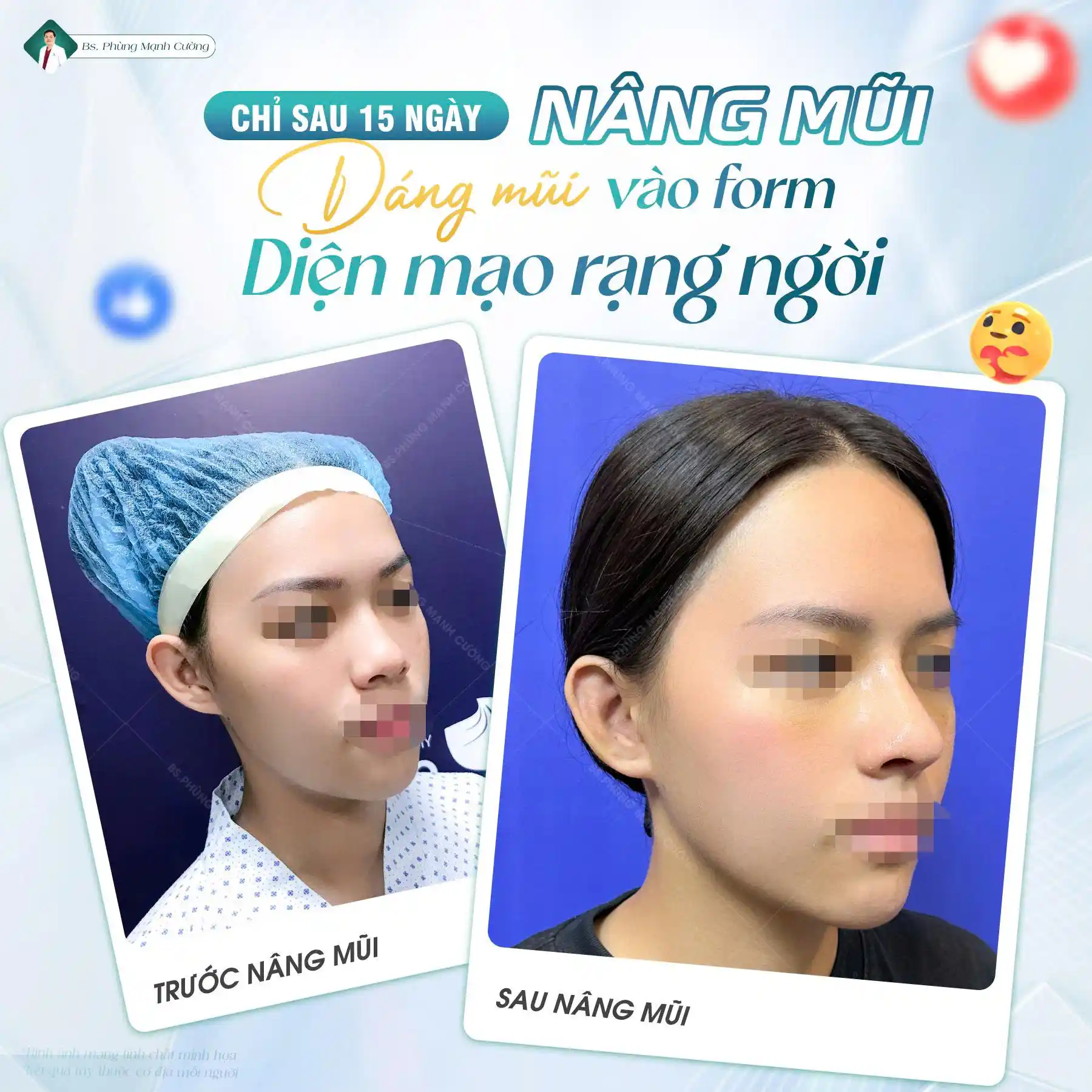 Tham khảo kết quả thực tế để đánh giá chất lượng cơ sở nâng mũi