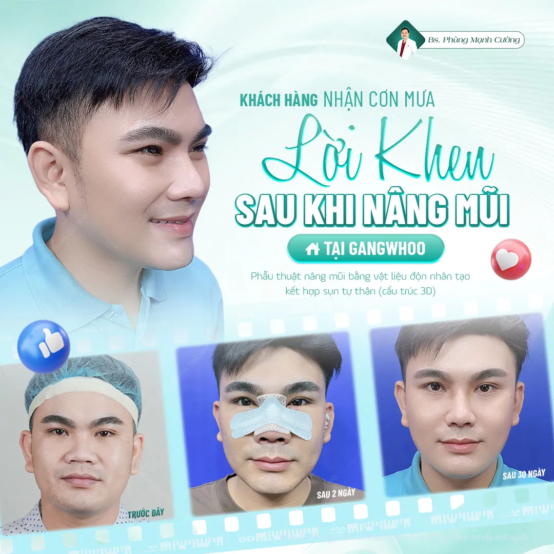 Tìm hiểu về nâng mũi cho nam giới