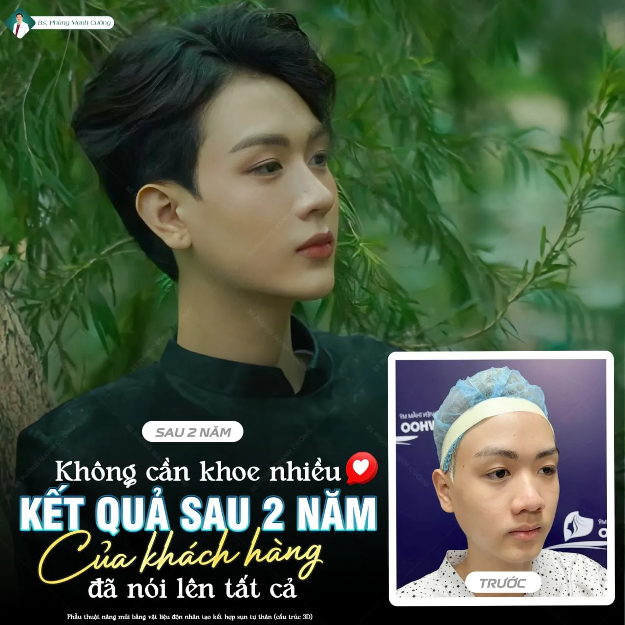 Lý do nam giới nên thực hiện nâng mũi