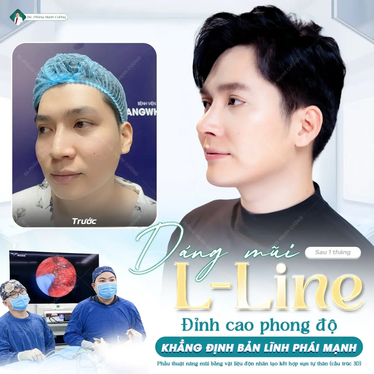 Tìm hiểu về dáng mũi L Line dành cho nam giới