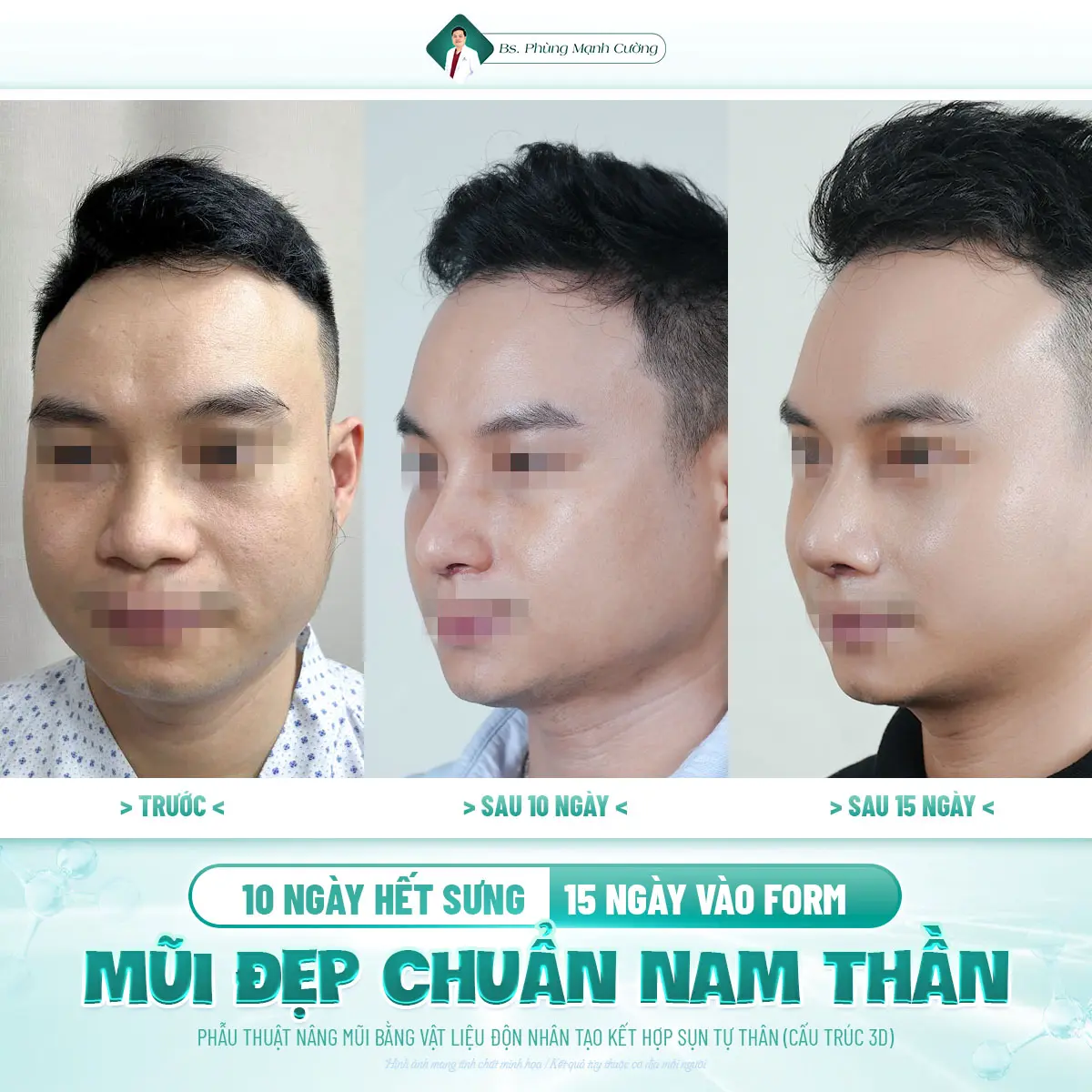 Tìm hiểu về giá nâng mũi nam mới nhất