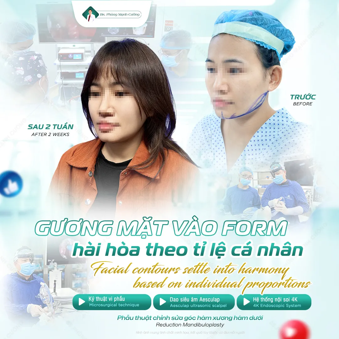 GỌT HÀM TRẢ GÓP - TRẢ TRƯỚC 0Đ LÃI SUẤT 0% - BS.CƯỜNG 12 Tìm hiểu thế nào là gọt hàm trả góp