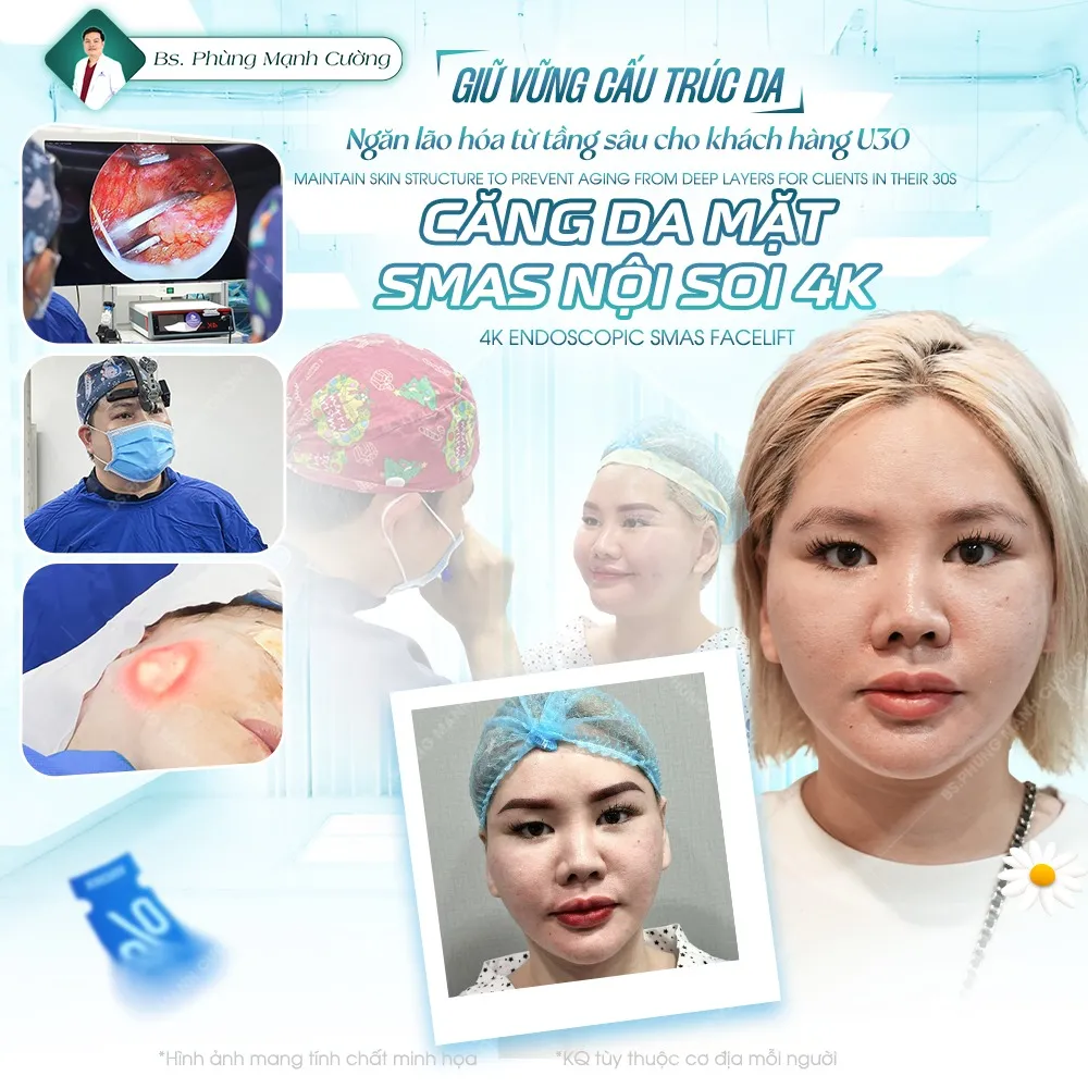 Căng da mặt SMAS là gì? Căng da SMAS có an toàn không?