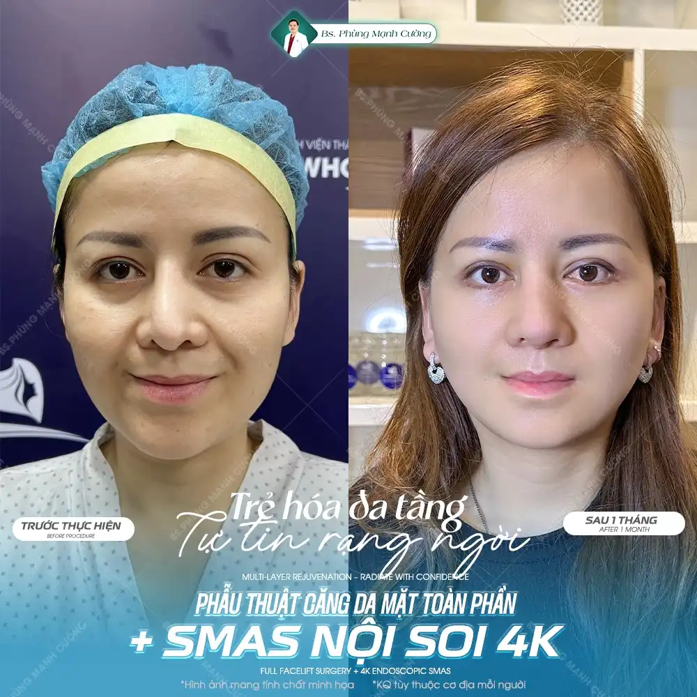 Căng da mặt SMAS là gì? Căng da SMAS có an toàn không?