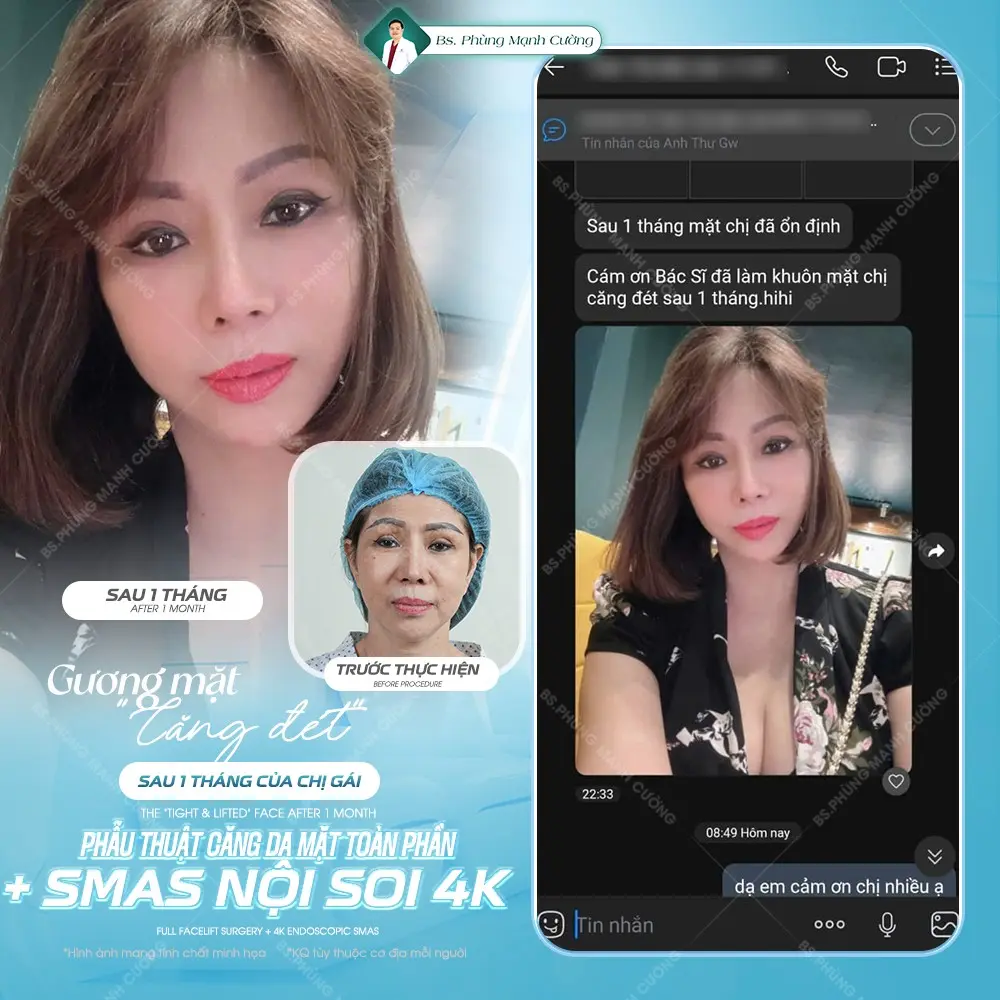 Căng da mặt SMAS là gì? Căng da SMAS có an toàn không?