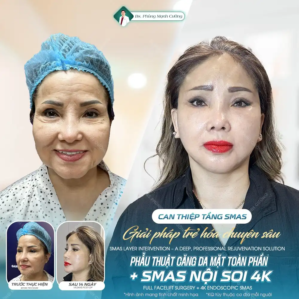 Căng da mặt SMAS là gì? Căng da SMAS có an toàn không?