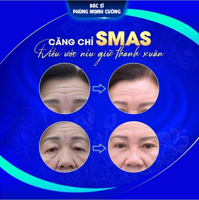 Phẫu thuật căng da mặt Smas tại bác sĩ Cường giúp lấy lại tuổi xuân cho khách hàng