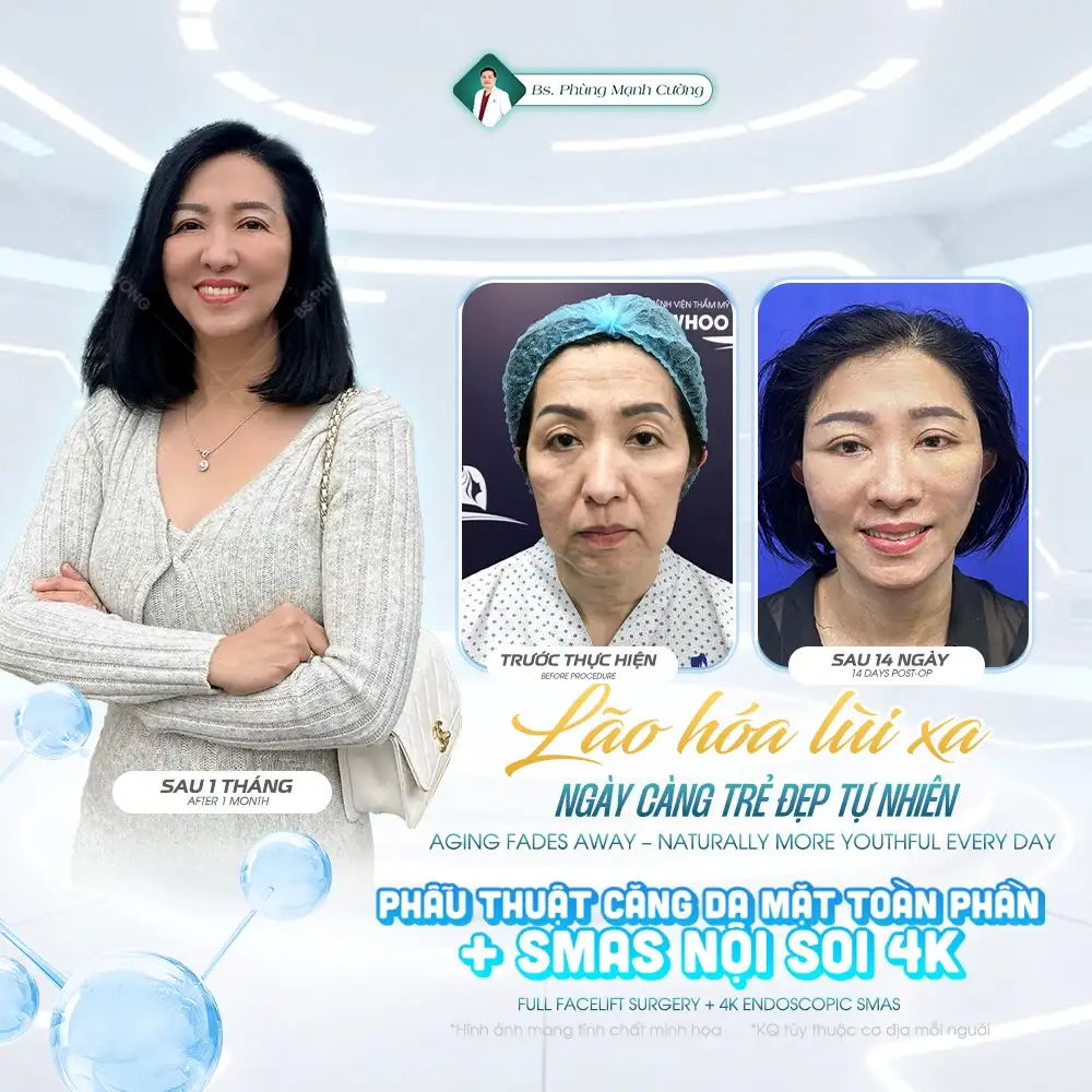 Căng da mặt SMAS là gì? Căng da SMAS có an toàn không?