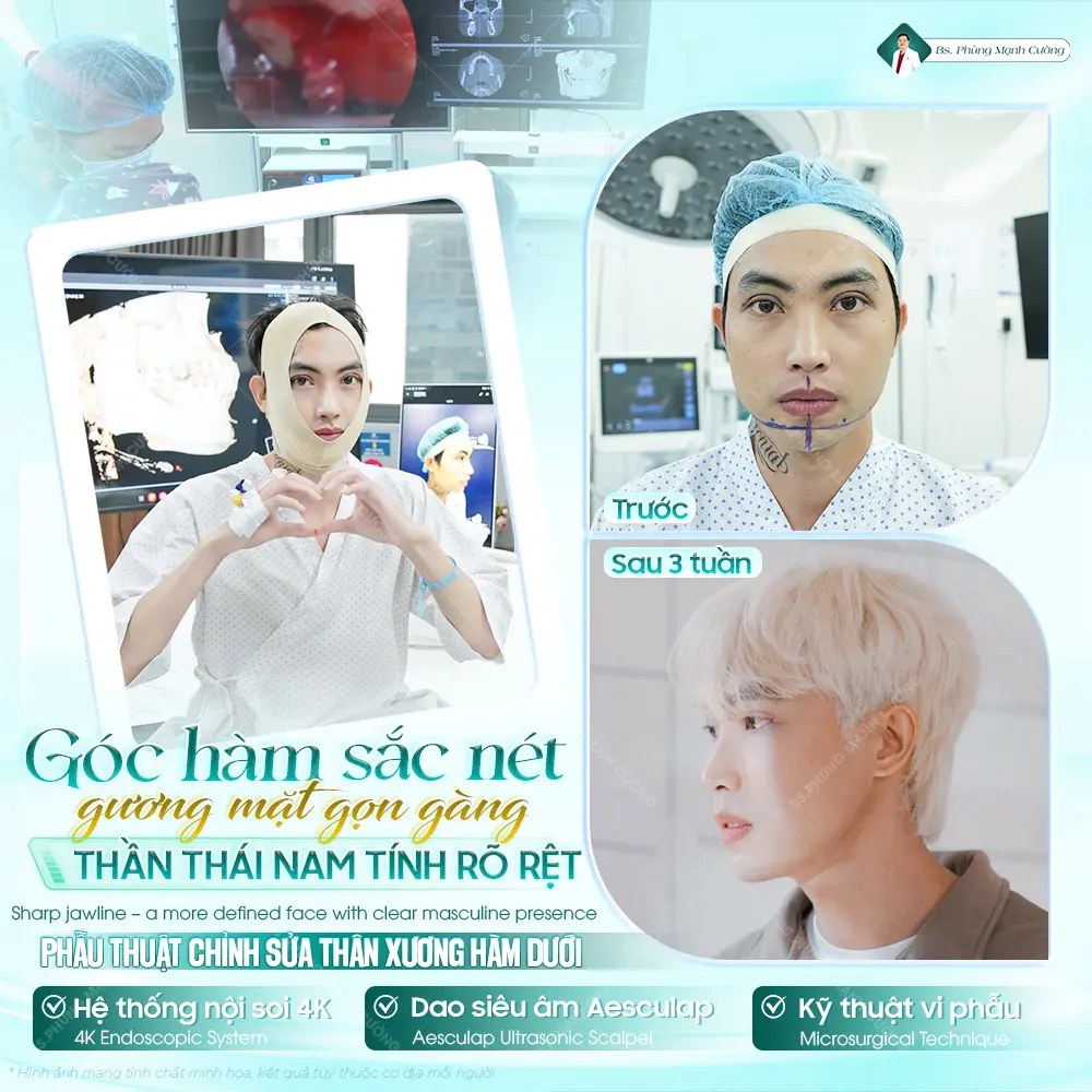 Tìm hiểu những lý do nên gọt hàm