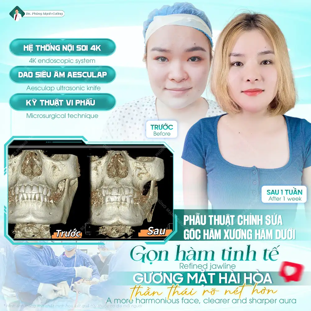 Những lợi ích của phẫu thuật gọt hàm