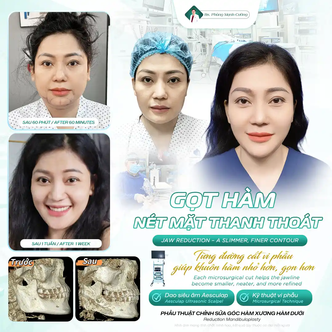 Gọt Hàm Bao Lâu Hết Sưng? Mẹo Chăm Sóc Hết Sưng Nhanh Chóng 13 Sau 3-6 tháng, xương hàm dưới sẽ vào form ổn định