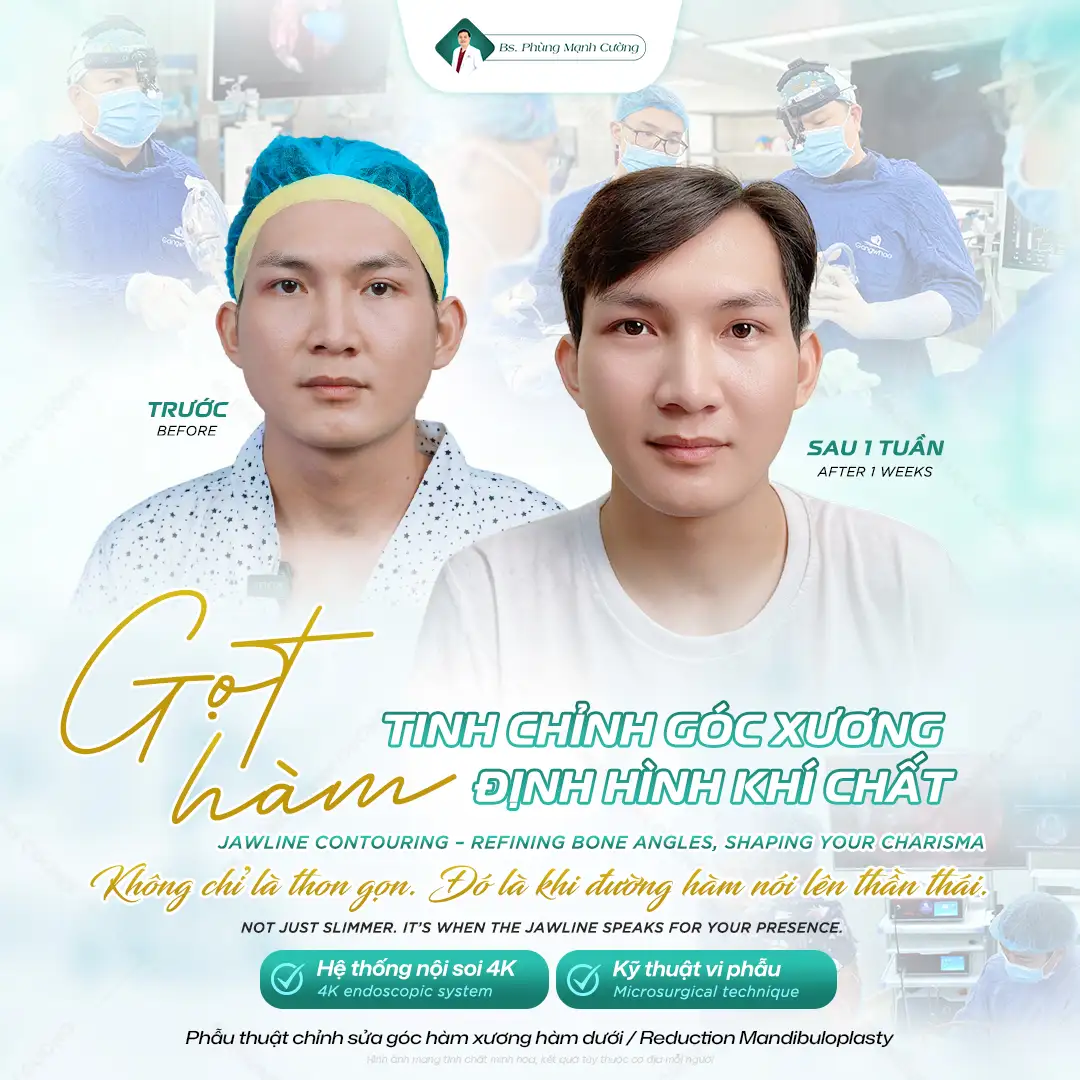 Gọt Hàm Bao Lâu Hết Sưng? Mẹo Chăm Sóc Hết Sưng Nhanh Chóng 14 Gọt hàm bao lâu hết sưng tùy thuộc vào công nghệ thực hiện