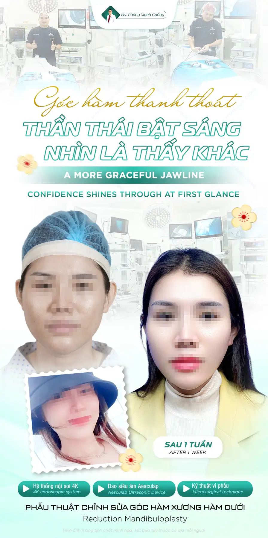 Gọt hàm có đau không? Cách hạn chế sưng đau hiệu quả 8 Trước gọt hàm khách hàng được tiêm thuốc tê giảm đau đầy đủ