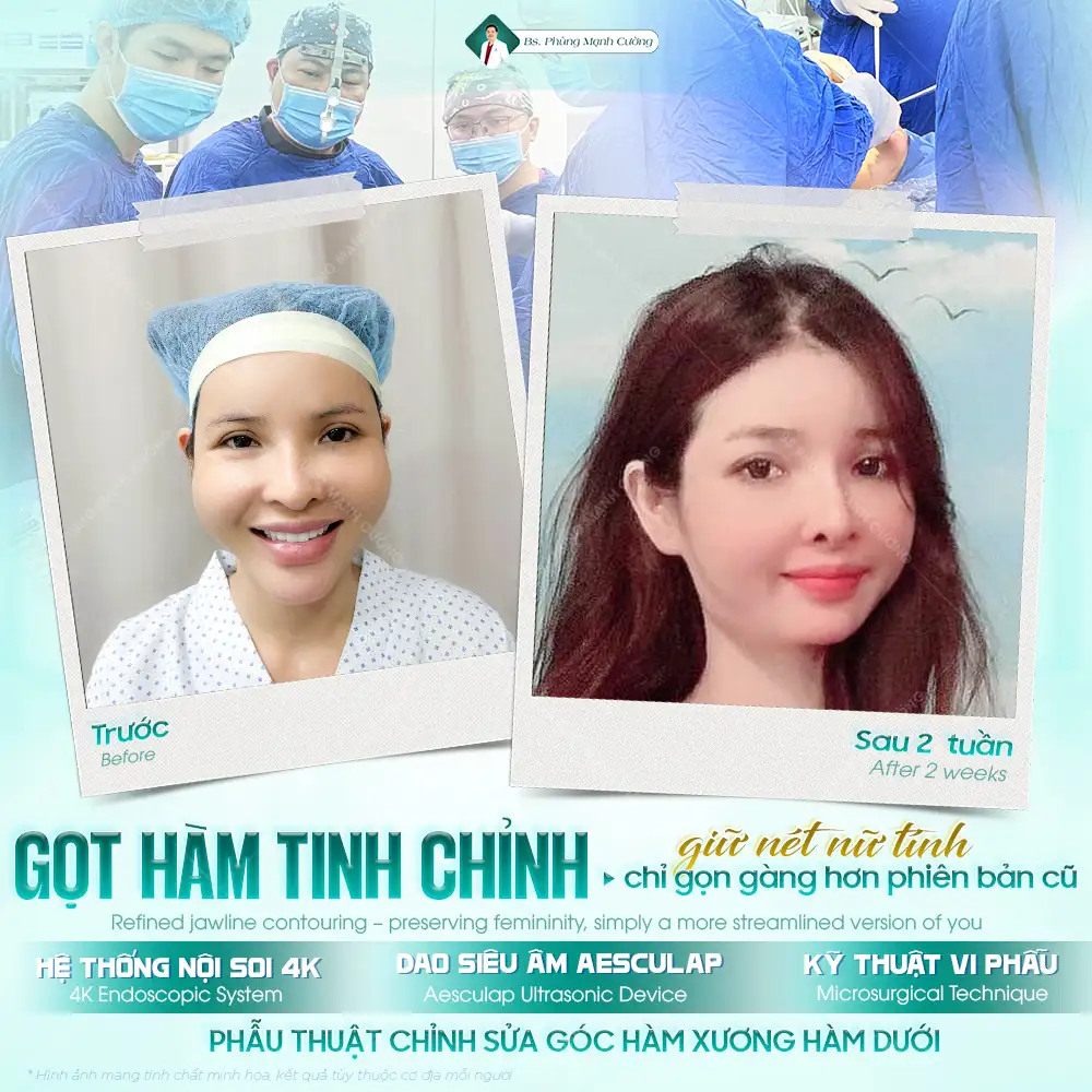 Gọt hàm có đau không? Cách hạn chế sưng đau hiệu quả 9 Sau phẫu thuật gọt hàm thường chỉ có cảm giác tê nhẹ