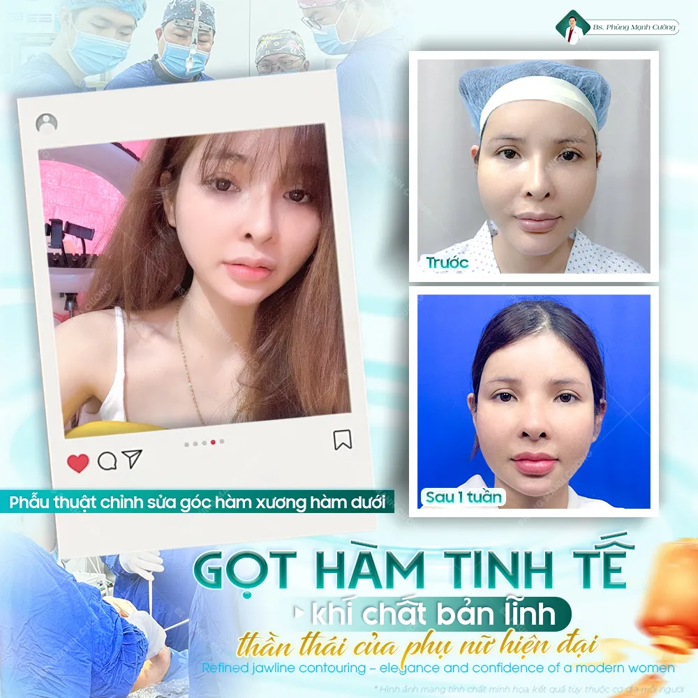 Đánh giá thực tế gọt hàm tại bác sĩ Phùng Mạnh Cường