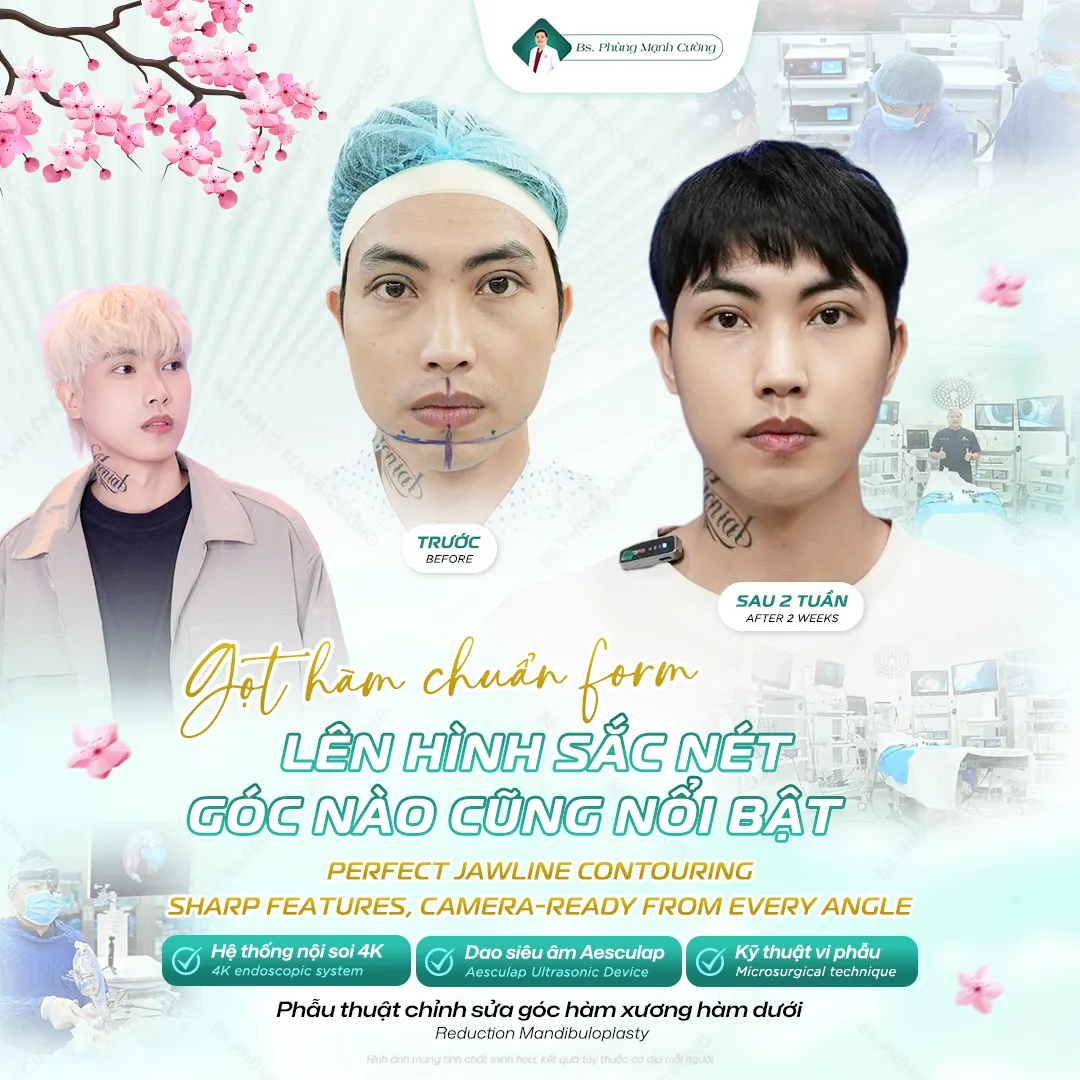 Phẫu thuật gọt hàm được tiến hành nhẹ nhàng, không đau