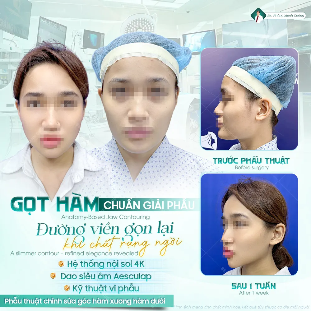 Review Gọt Hàm Có Tốt Không