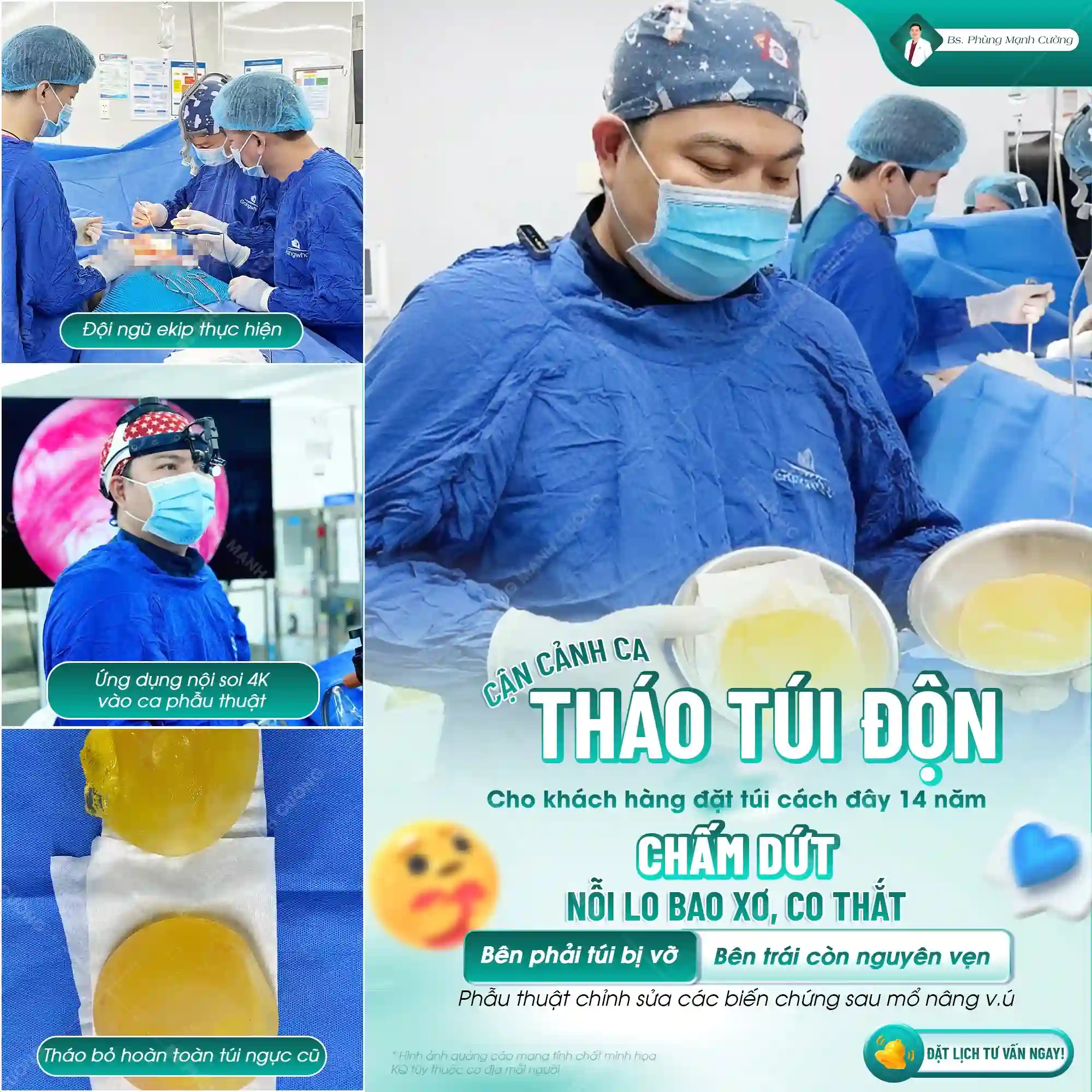 Bao xơ là một trong những biến chứng phổ biến sau khi nâng ngực