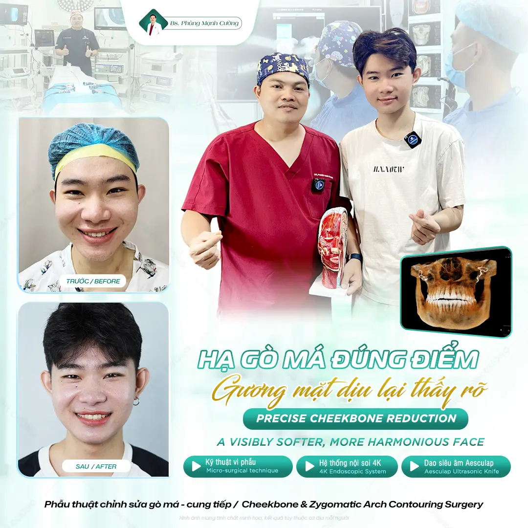 Những lưu ý quan trọng khi thực hiện hạ gò má