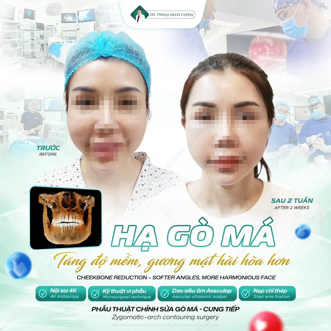 Kết quả hạ gò má thường duy trì vĩnh viễn