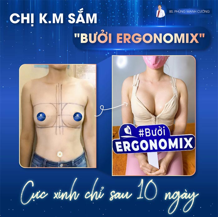 Khách hàng đã thực hiện nâng ngực Ergonomix tại địa chỉ của Bác sĩ Cường