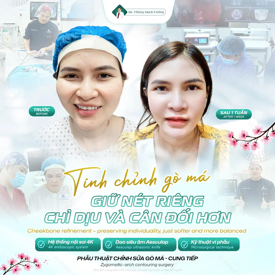 Thông thường, sau khoảng 7–10 ngày gò má sẽ vào form ổn định