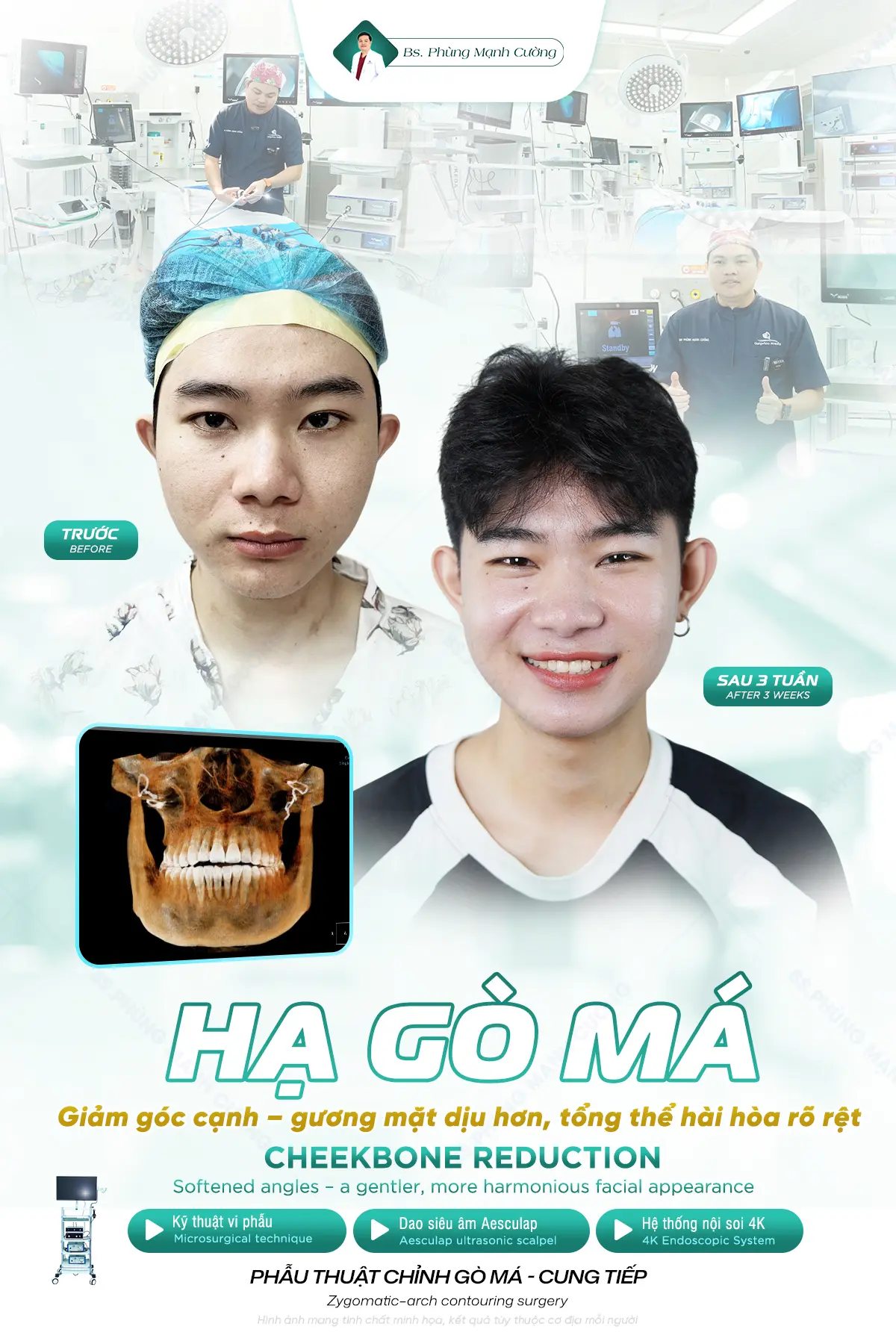 Hạ gò má cho nam giới có khác biệt so với nữ 