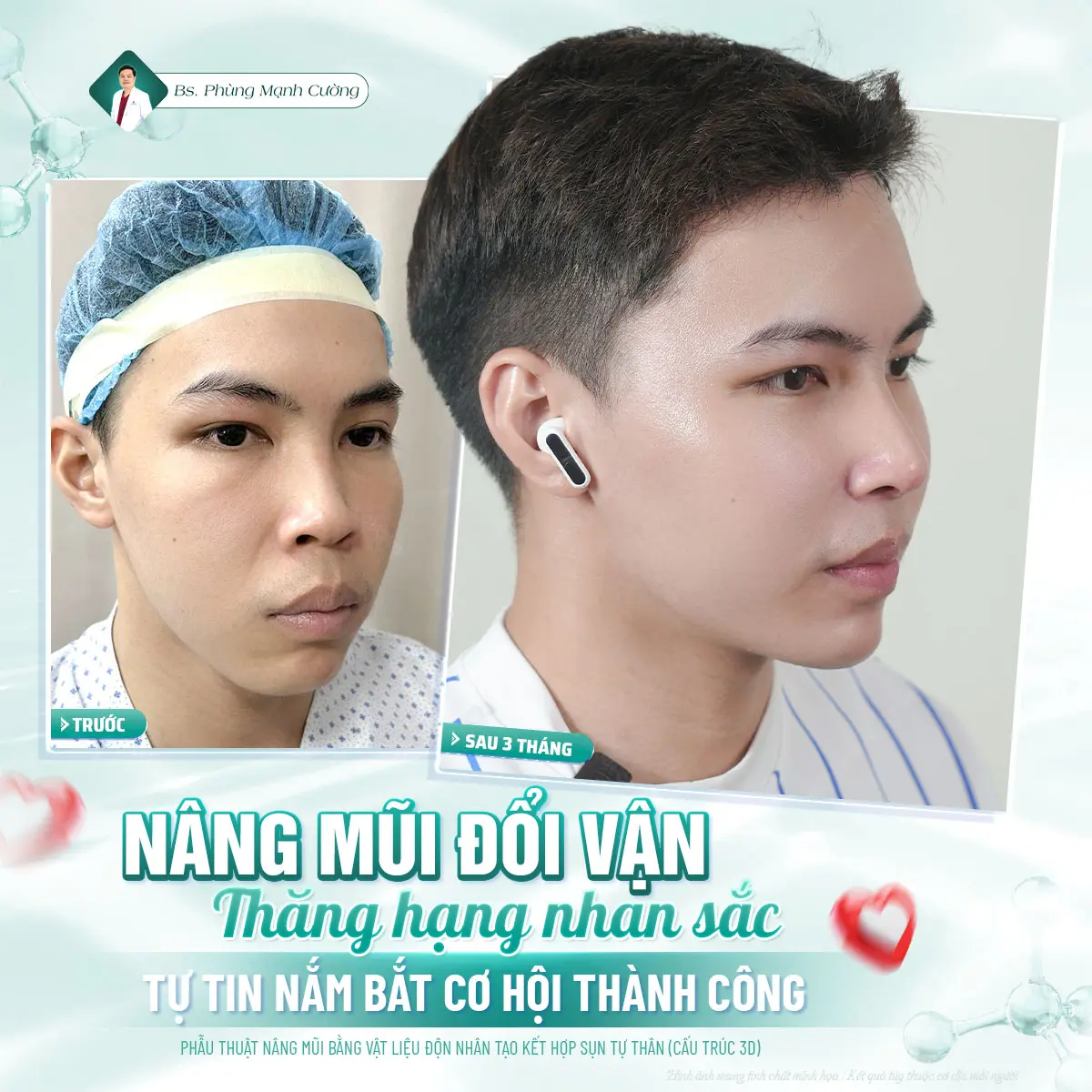 Nâng mũi giúp cải thiện diện mạo và sự tự tin 