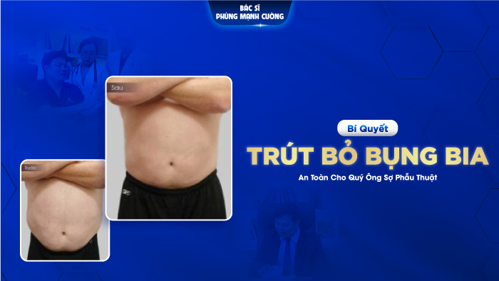 Bí Quyết Giúp Quý Ông “Trút Bỏ Bụng Bia’’ 5 Năm Tuổi An Toàn, Không Cần Phẫu Thuật