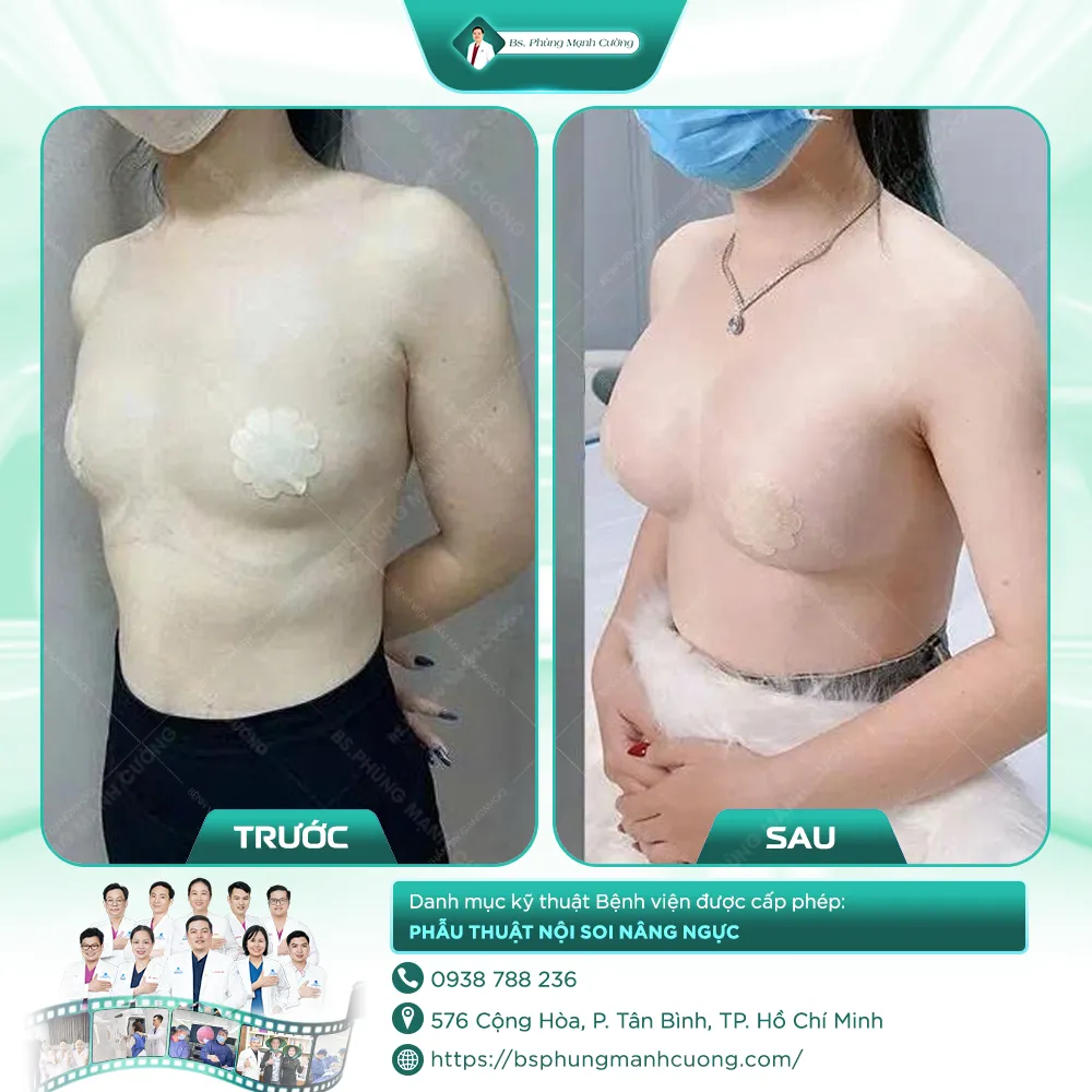 Hình Ảnh Khách Hàng Nâng Ngực