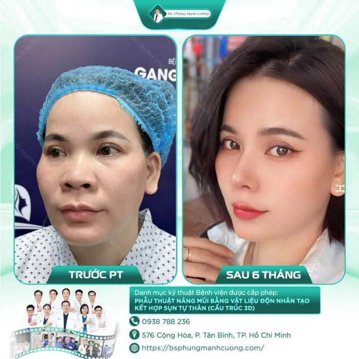 Hình Ảnh Khách Hàng Nâng Mũi