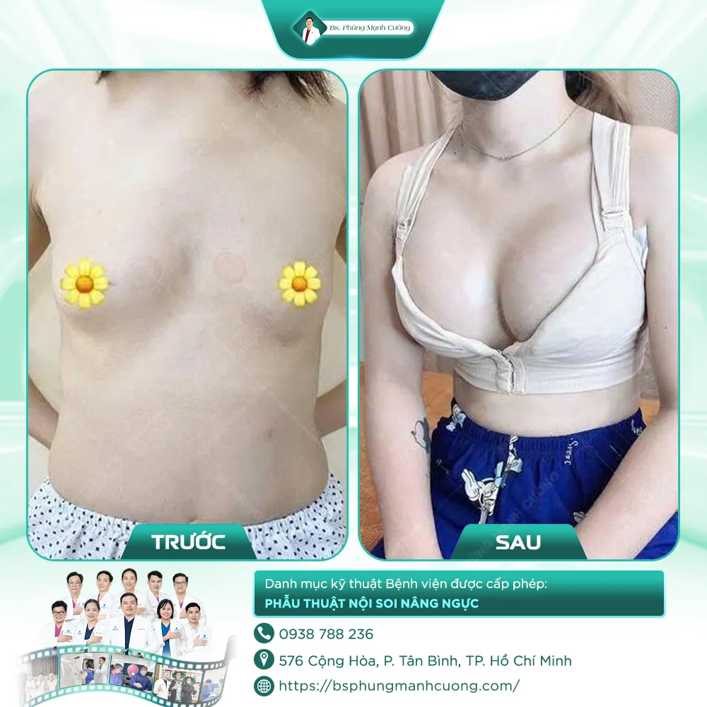 Hình Ảnh Khách Hàng Nâng Ngực
