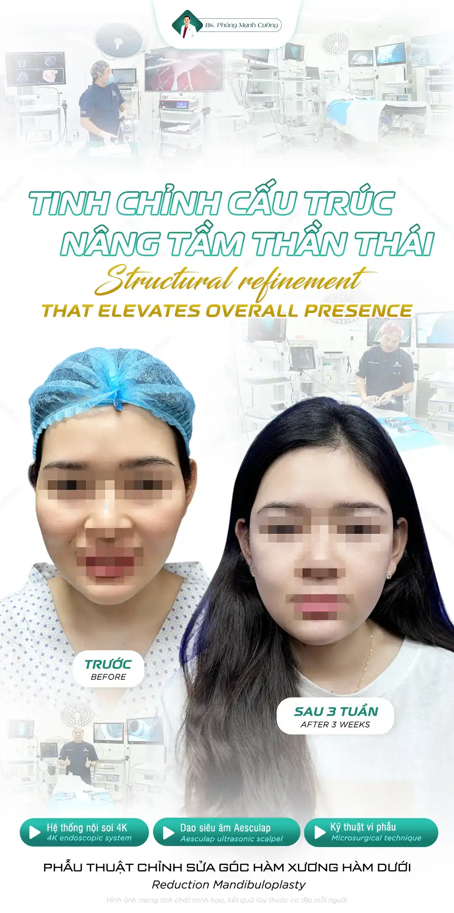 Gọt hàm vuông là gì? Những điều cần biết trước khi thực hiện 8 Tìm hiểu thế nào là gọt hàm vuông