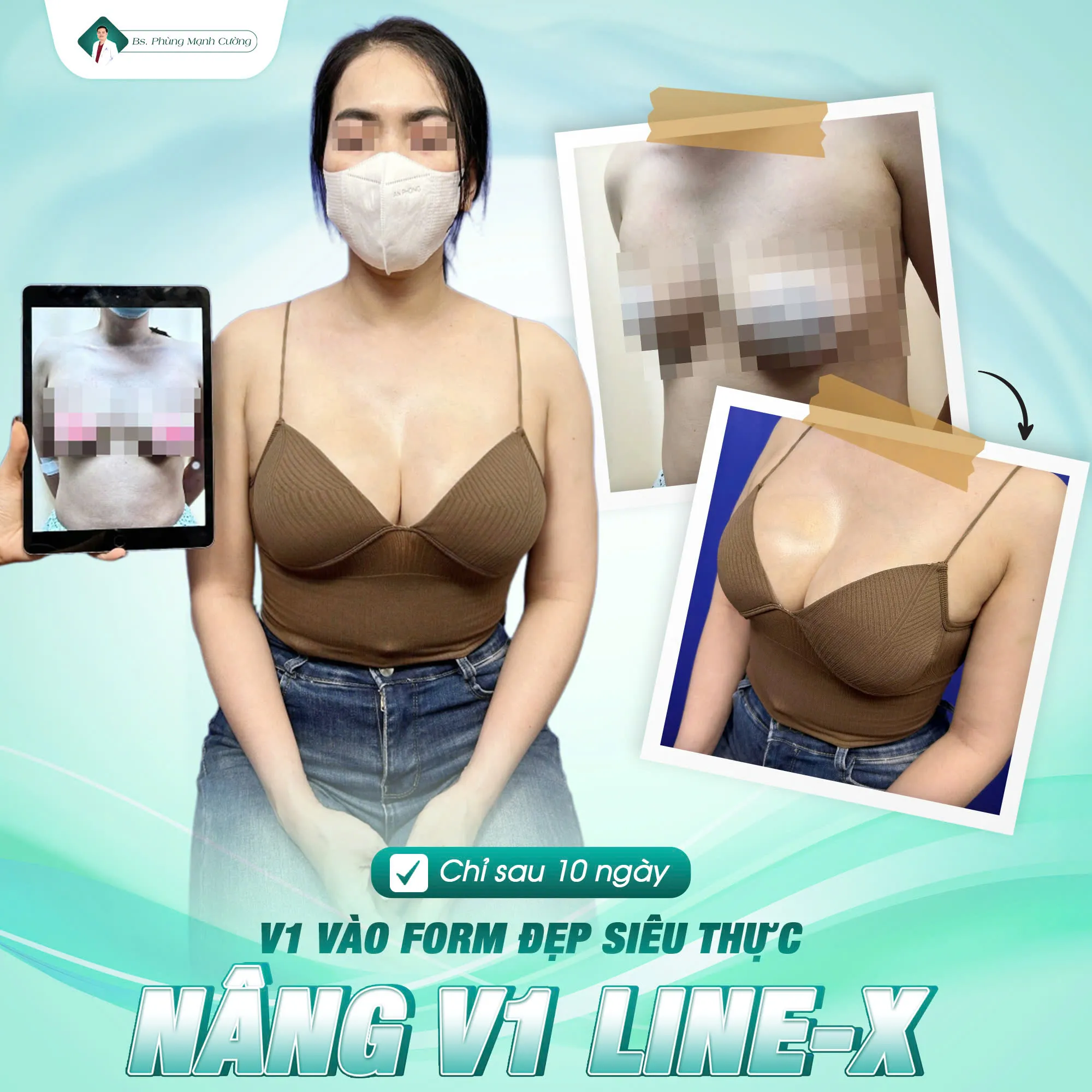 Bí quyết nâng ngực đẹp tự nhiên tại Bác sĩ Phùng Mạnh Cường