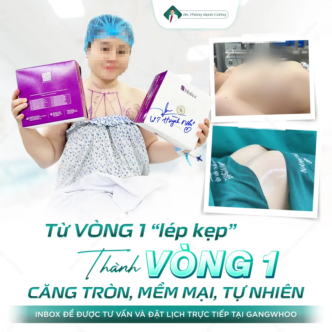 Phẫu thuật nâng ngực và những điều cần biết khi thực hiện 32 Những trường hợp nên thực hiện nâng ngực