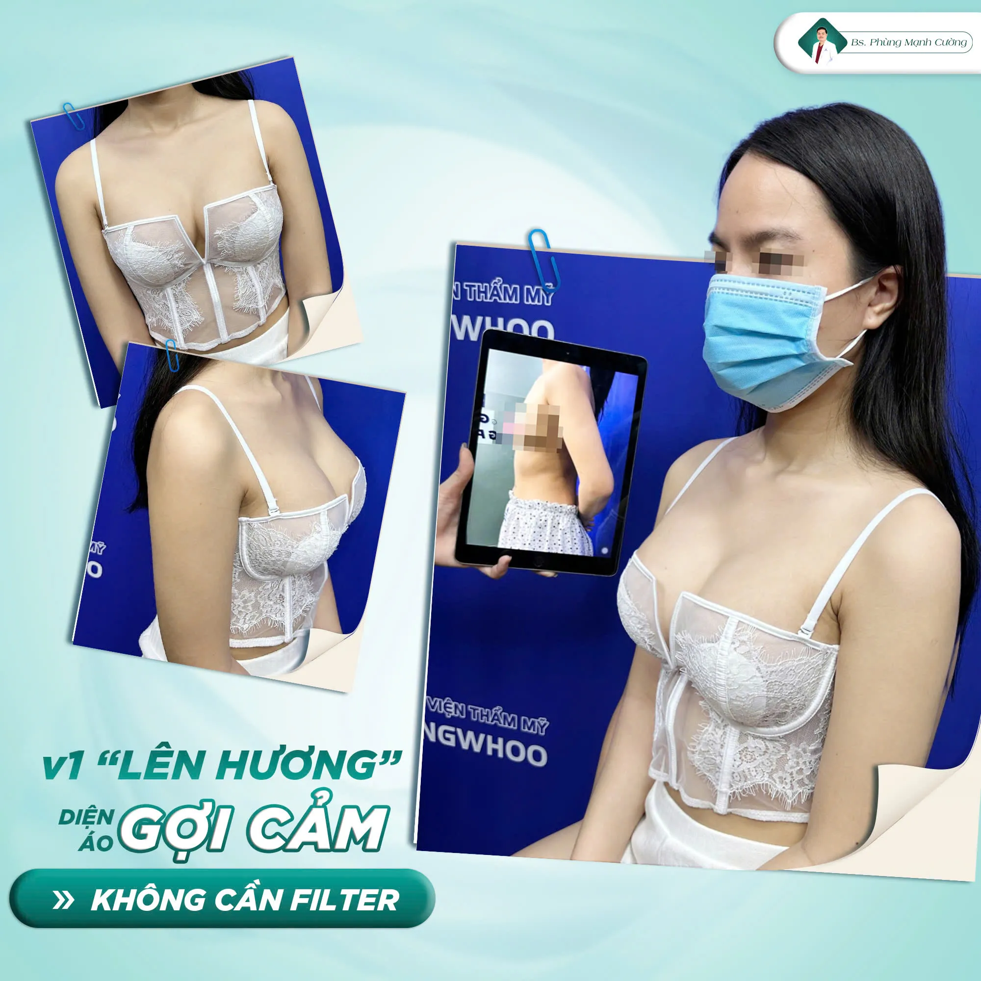 Bí quyết nâng ngực đẹp tự nhiên tại Bác sĩ Phùng Mạnh Cường
