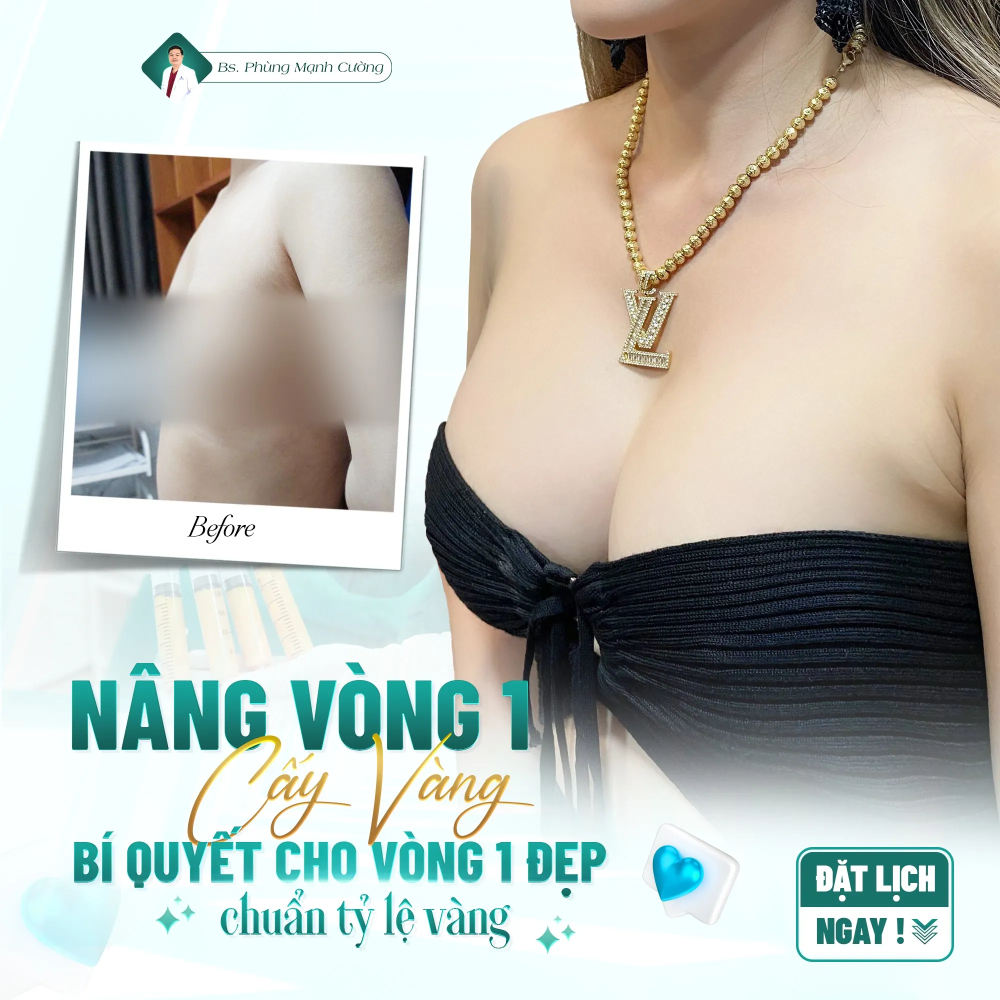 Phẫu thuật nâng ngực và những điều cần biết khi thực hiện 34 Nâng ngực cấy mỡ tự thân