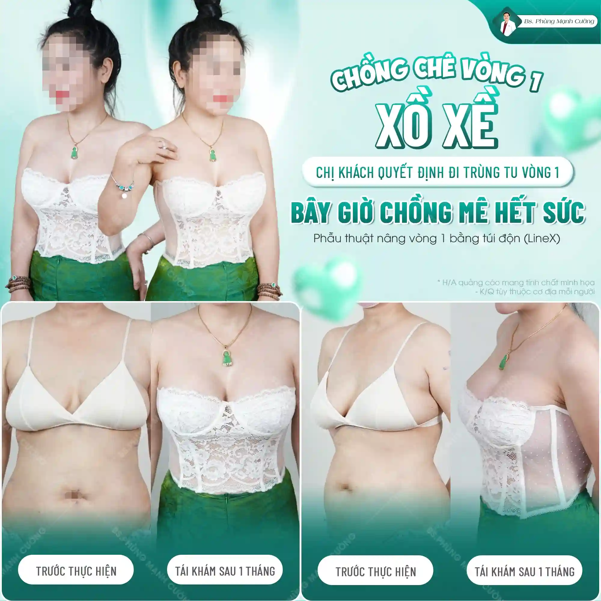 Phẫu thuật nâng ngực và những điều cần biết khi thực hiện