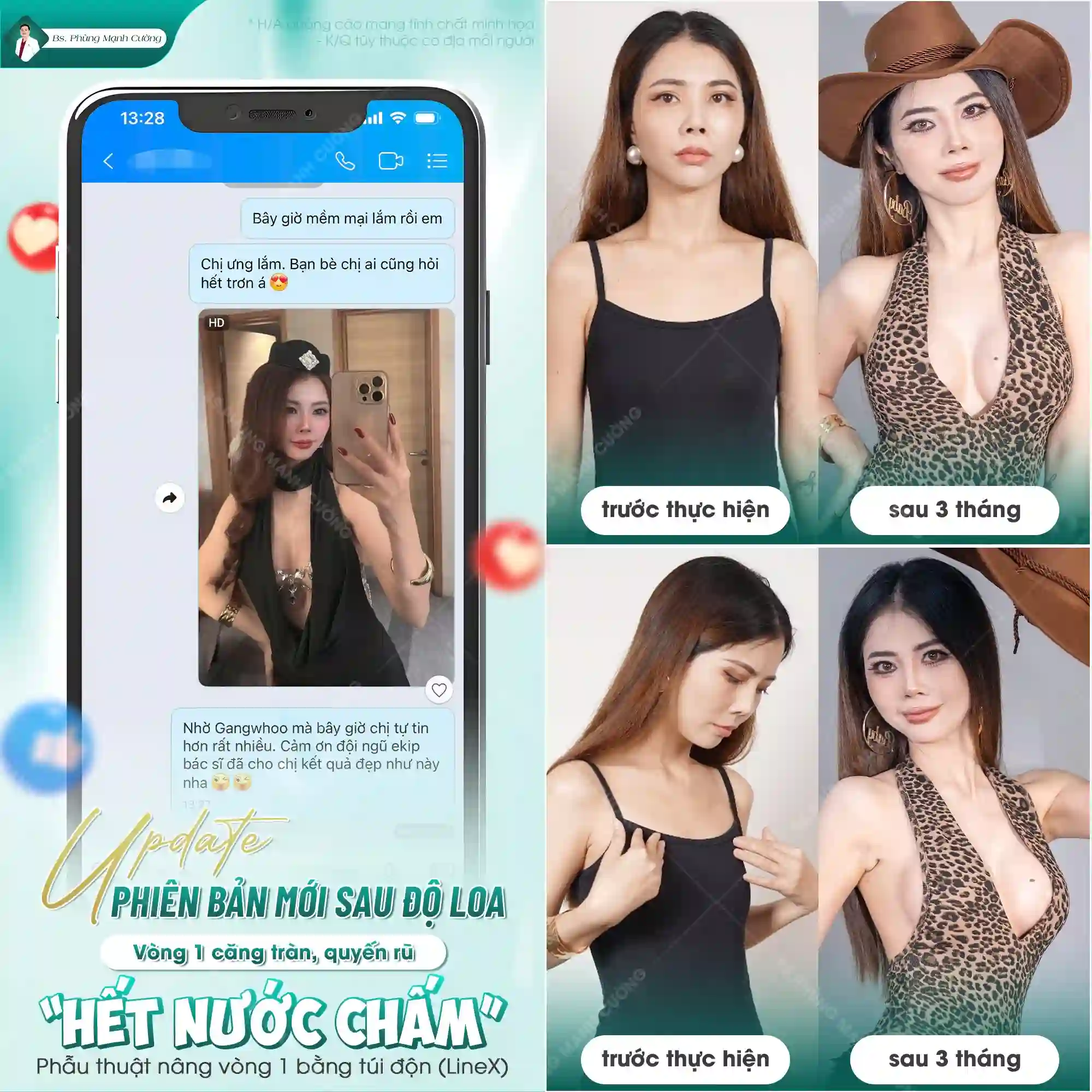 Phẫu thuật nâng ngực và những điều cần biết khi thực hiện