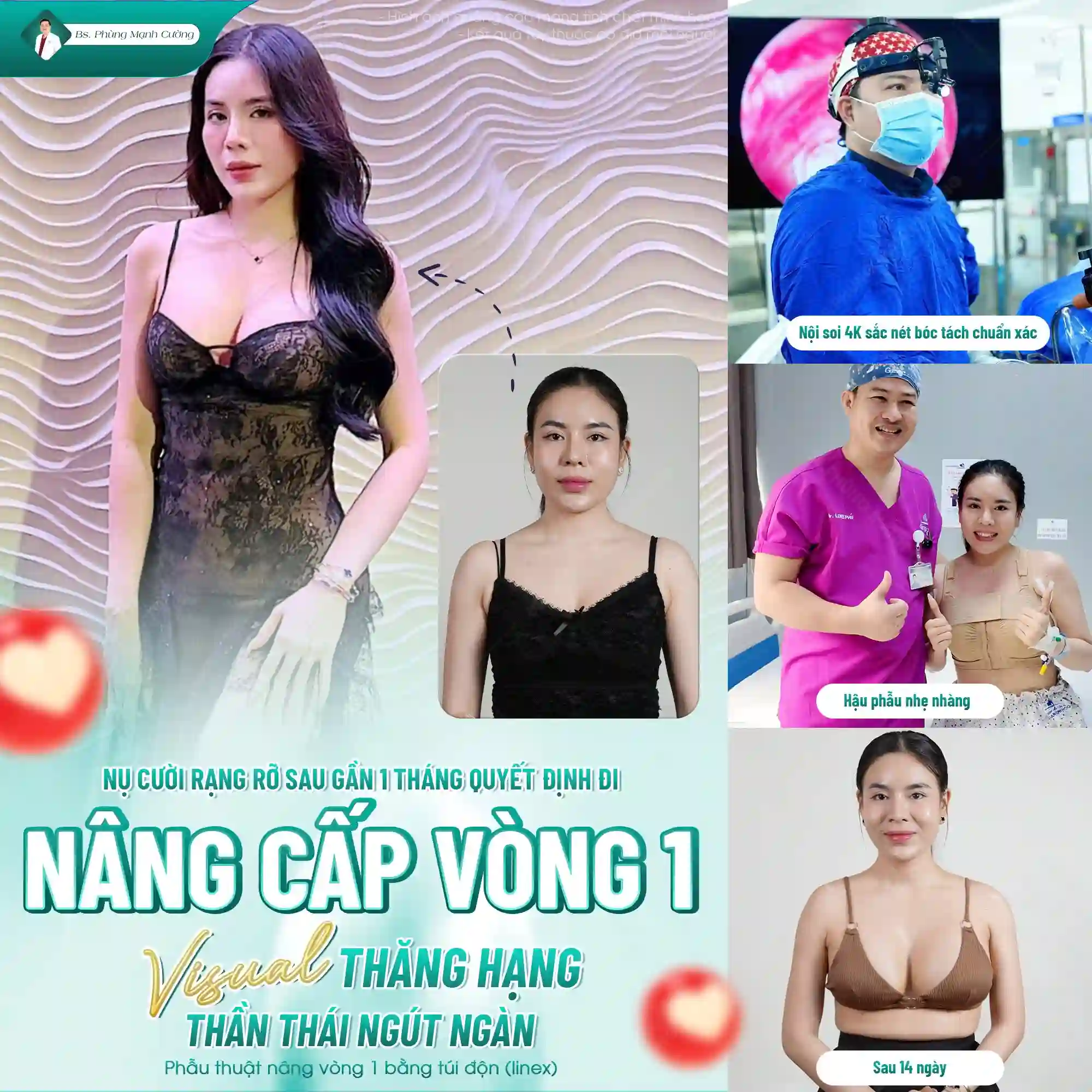 Phẫu thuật nâng ngực và những điều cần biết khi thực hiện