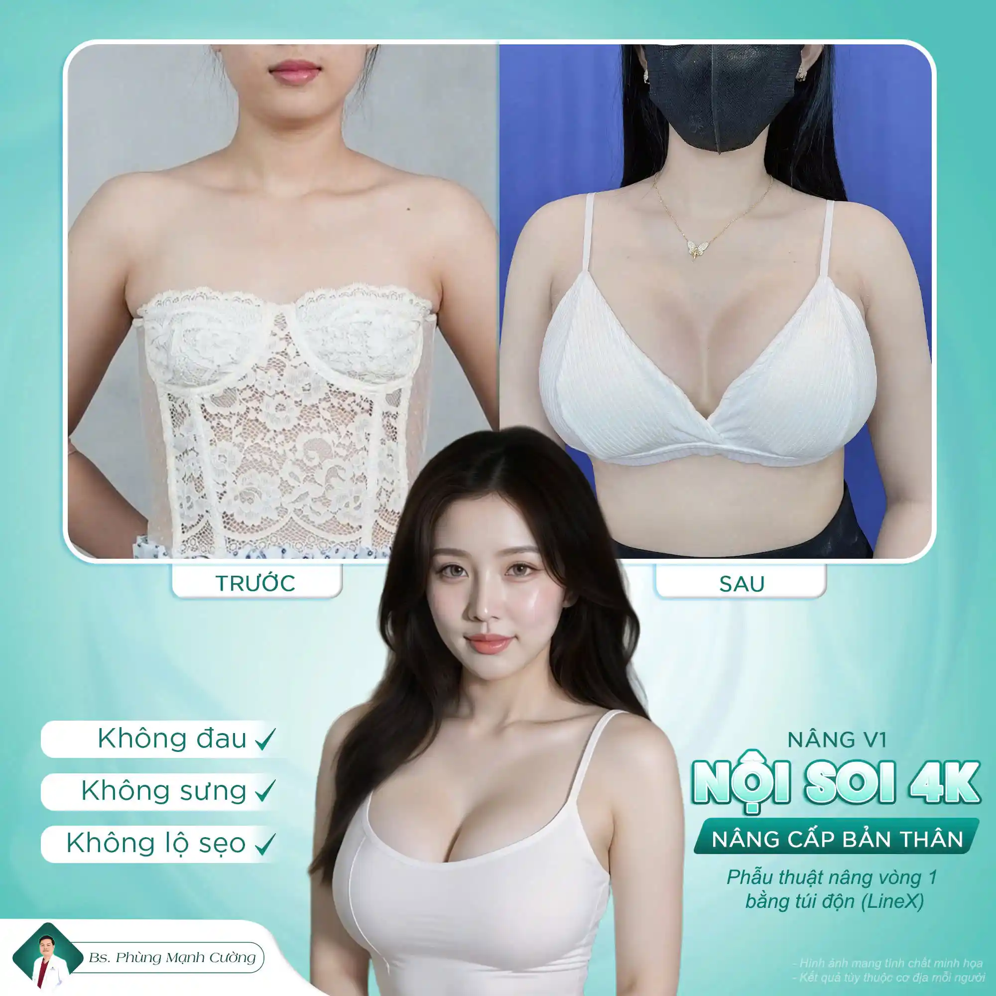 Phẫu thuật nâng ngực và những điều cần biết khi thực hiện