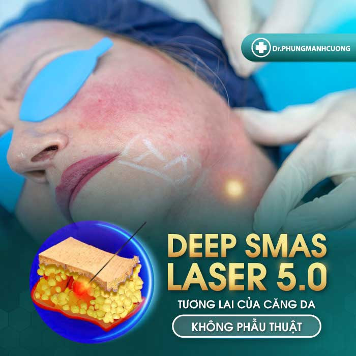 Căng da mặt trẻ hoá Deep Smas Laser 5.0 - Công nghệ căng da mặt được chuyển giao từ Hàn Quốc