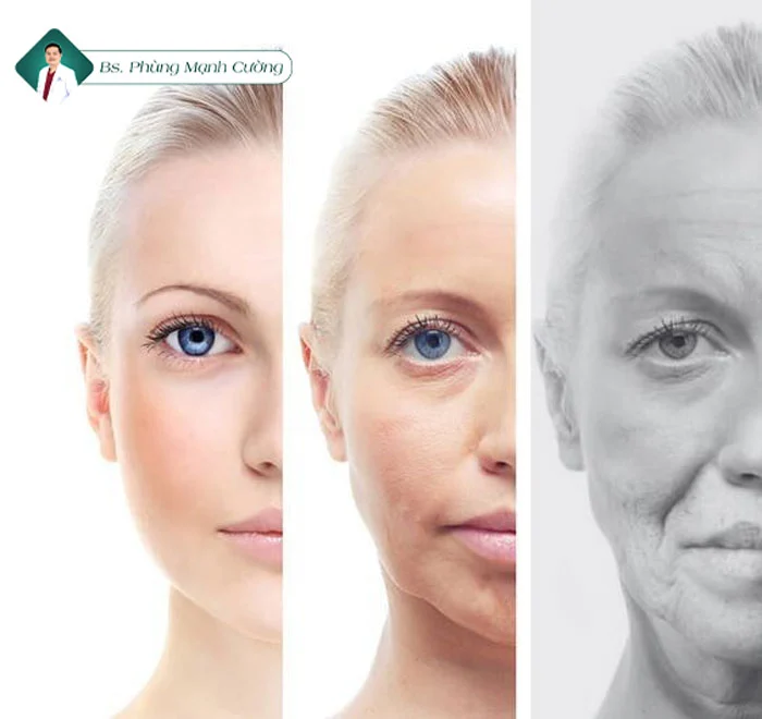 Cấy chỉ collagen căng da mặt không phù hợp với đối tượng bị lão hoá nặng